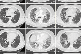 impact de l infection par covid sur la fibrose pulmonaire preexistante opa pratique
