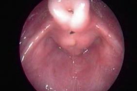 Stridor De L Enfant Laryngomalacie Ou Malformation Opa Pratique