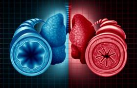 Asthme éosinophique, le benralizumab réduit les bouchons muqueux 